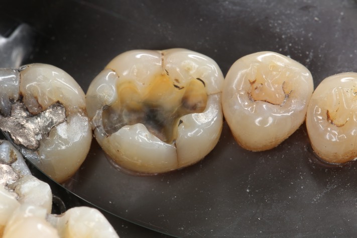 Alan Tamashiro #30 caries removal