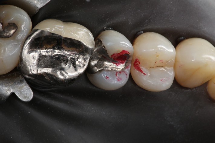 Kyle Chock #13 pre-op