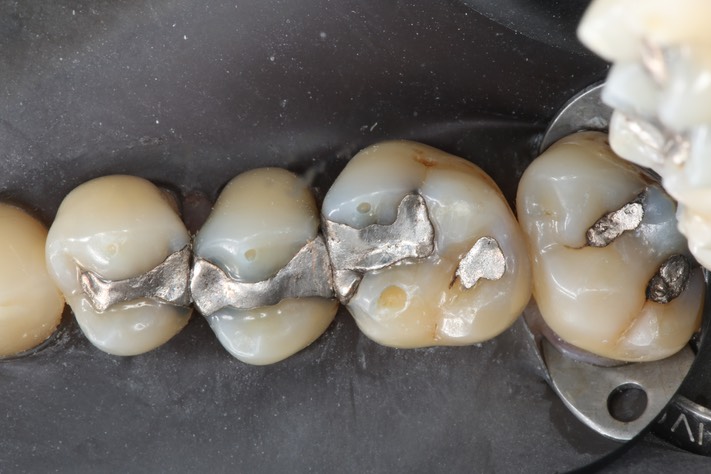 Gary Umeda #3,4,5 pre-op