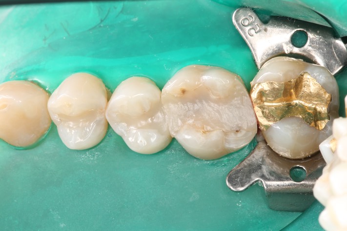 Mendel Sato #3 pre-op