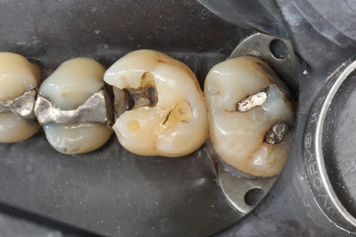 Gary Umeda #3 amalgam removal