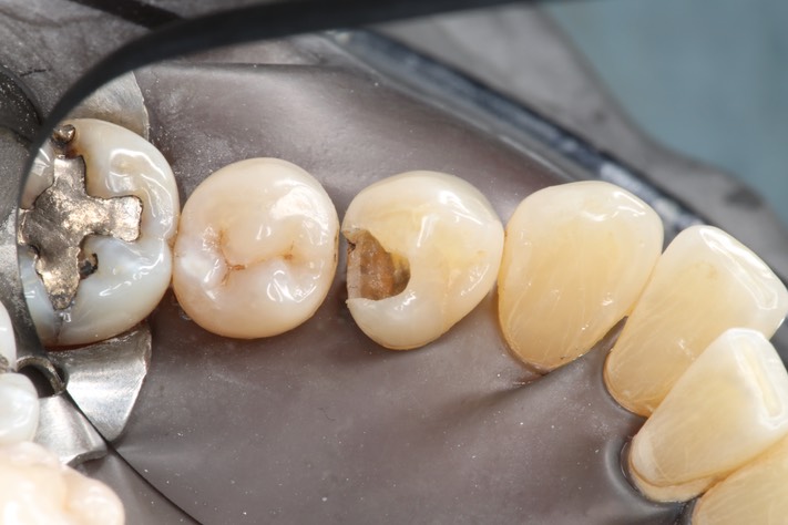 Larry Fujioka #28 caries removal