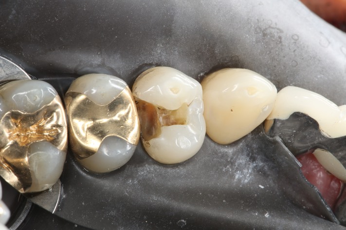 Scott Kanamori #12 caries removal