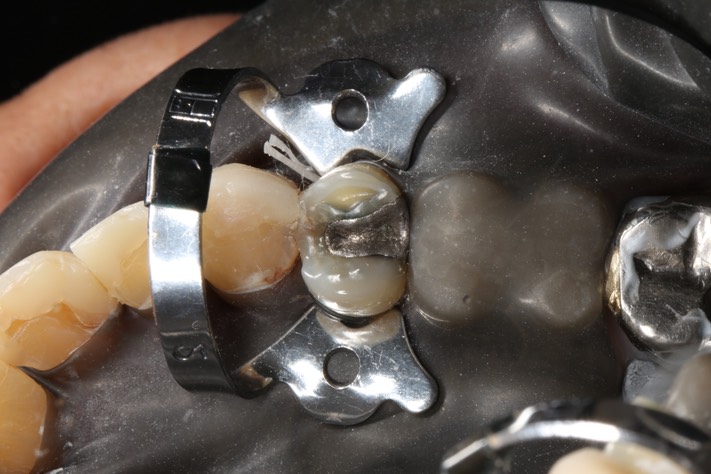 1Wayne Chin #5 pre-op