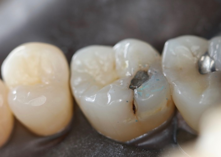 Joe Cha #3 pre-op lingual