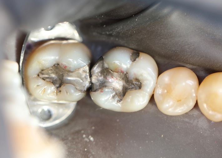 Kyle Chock #30 pre-op