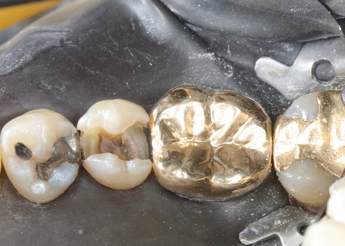 Frank Fukuda #20 amalgam removal