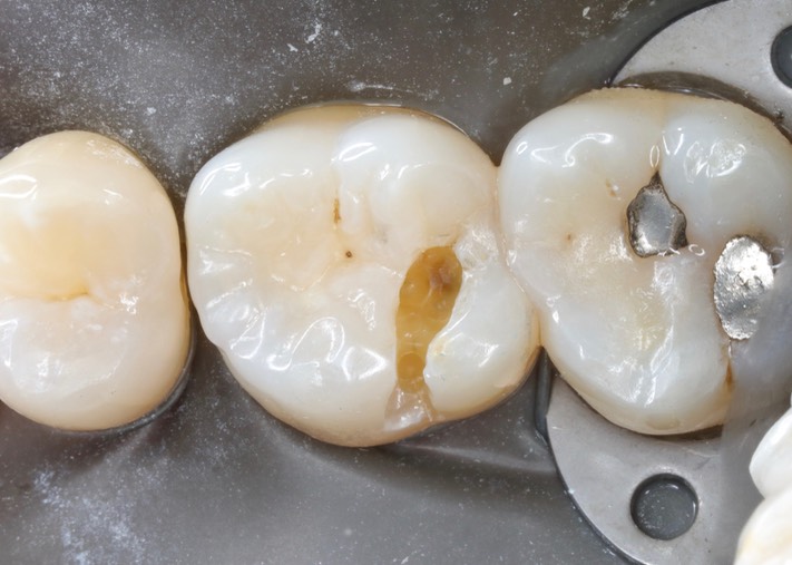 Joe Cha #3 amalgam removal