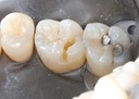 Joe Cha #3 amalgam removal lingual view