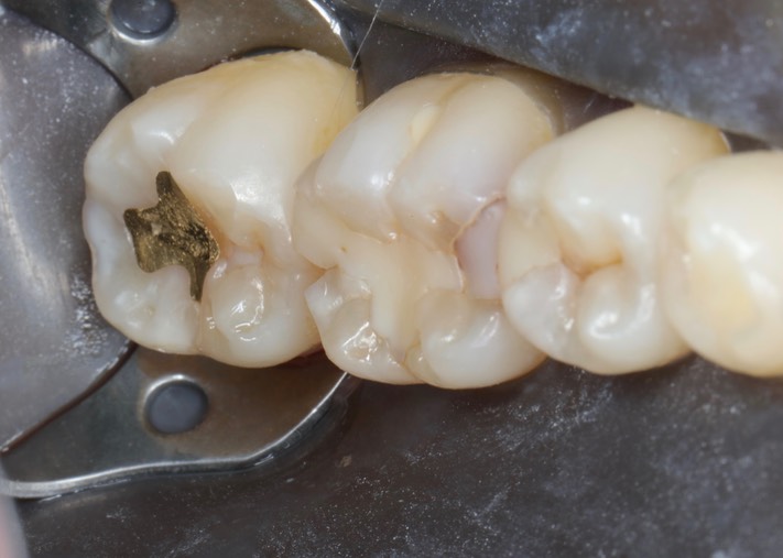 Gary Umeda #19-20 pre-op