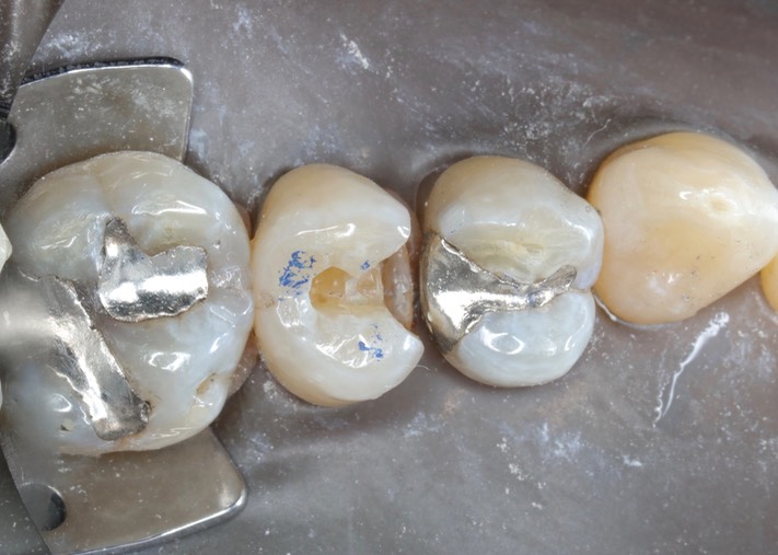 Joe Cha #13 amalgam removal