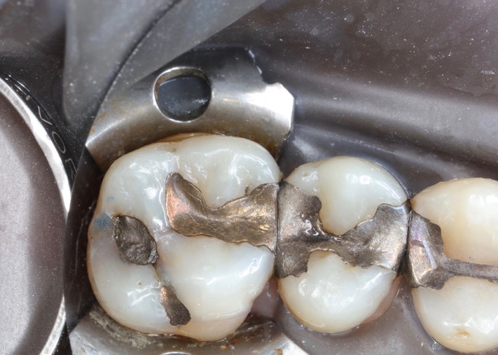 Matt Dodson #14 pre-op