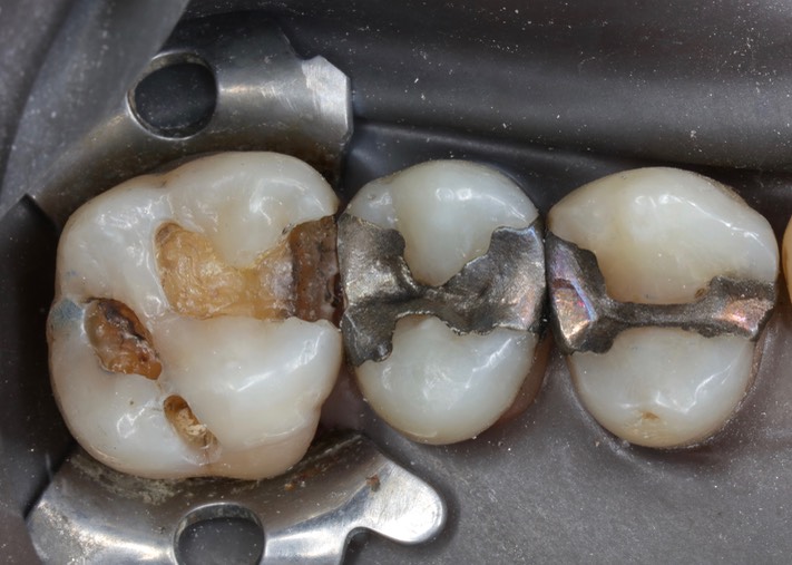 Matt Dodson #14 amalgam removal