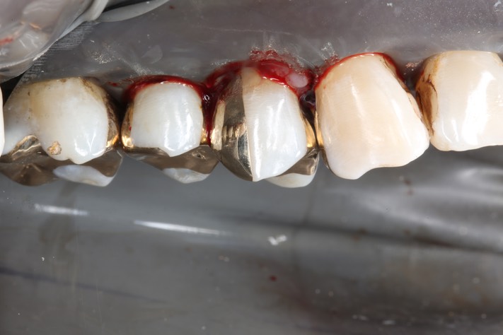 34Larry Fujioka #11,12 finish buccal