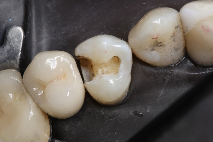 55Bryan Sato #12 caries removal