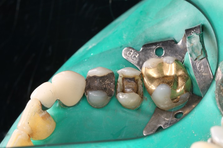 59Mendel Sato #4 caries removal