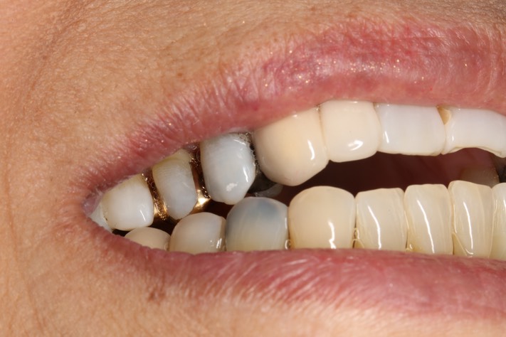 65Mendel Sato #4 right lateral movement