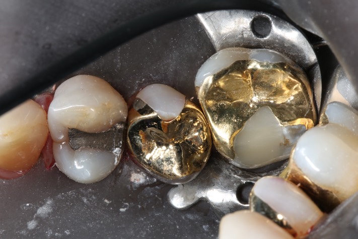 69Wes Sato #4 buccal fracture