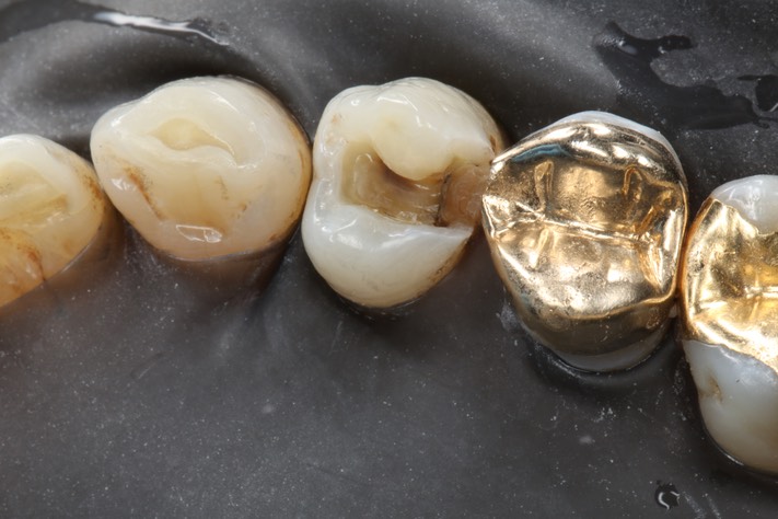 74Russ Tabata #5 caries removal