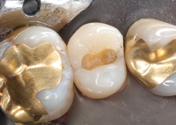 Alan Chinn #13 caries removal