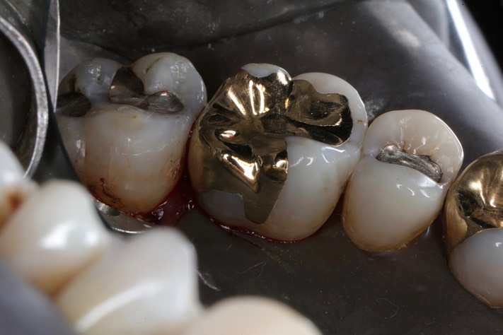 Alan Chinn #14 finish lingual