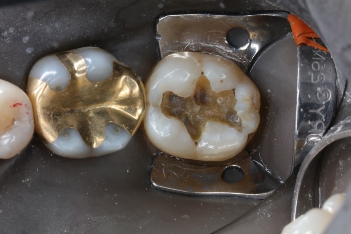 Alan Chinn #18 amalgam removal