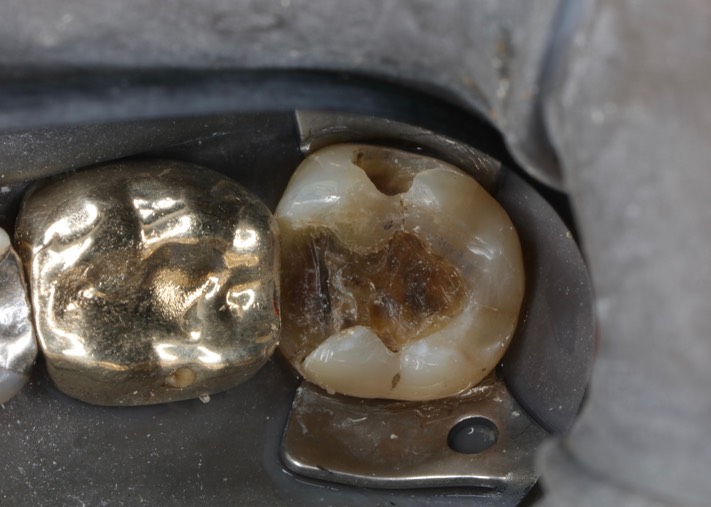 Alan Chinn #18 caries removal