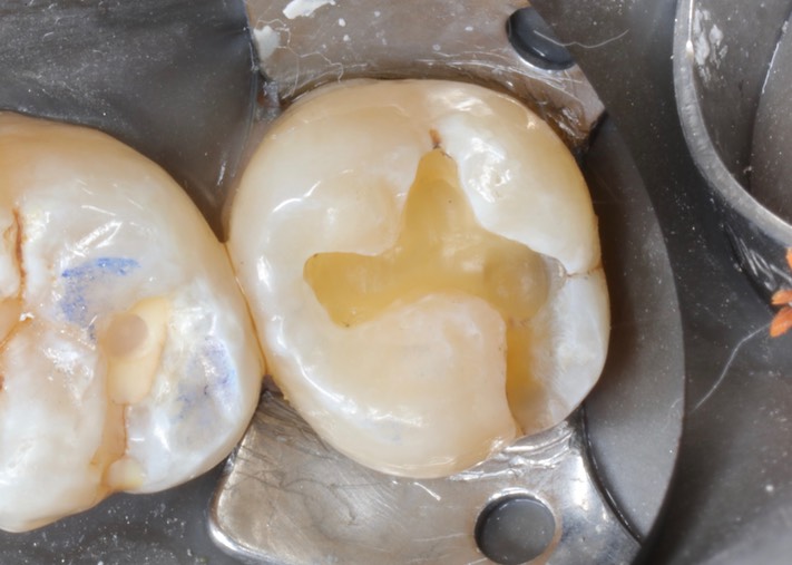 Alan Chinn #2 amalgam removal