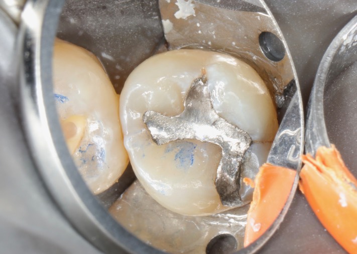 Alan Chinn #2 pre-op 