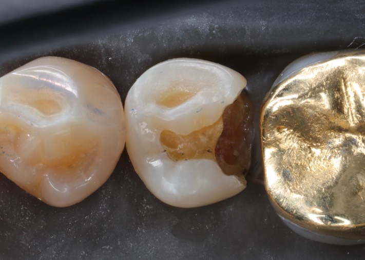 Alan Chinn #20 caries removal