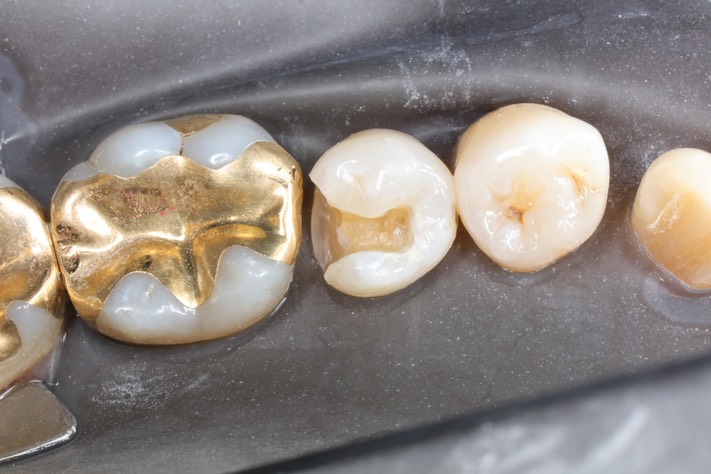 Alan Chinn #29 composite removal