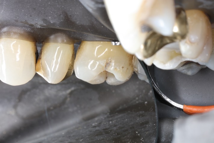 Alan Chinn #3 buccal