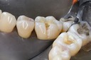 Alan Chinn #30 prep buccal view