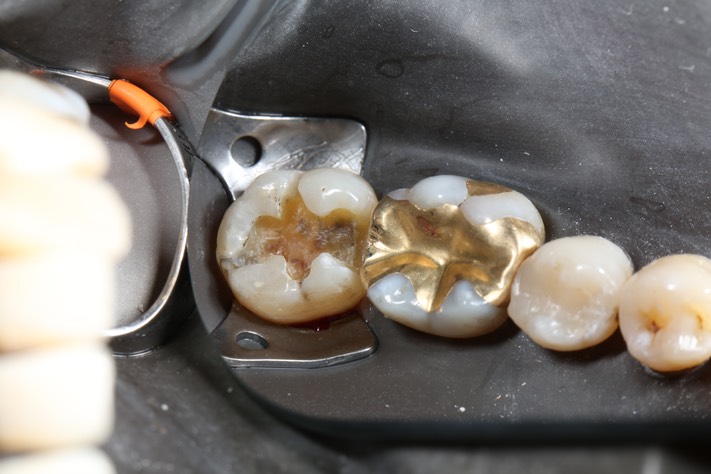 Alan Chinn #31 caries removal