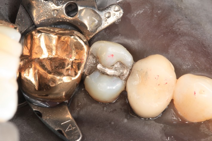 Alan  Chinn #13 pre-op