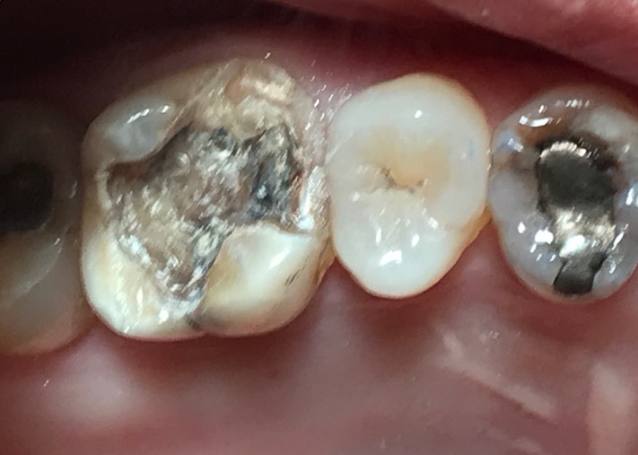 Brian Sato #14 amalgam removal