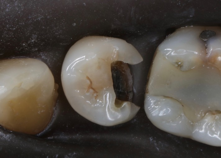 Brian Sato #20 amalgam removal