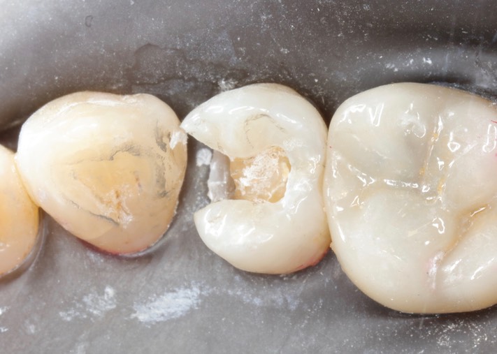 Brian Sato #5 amalgam removal