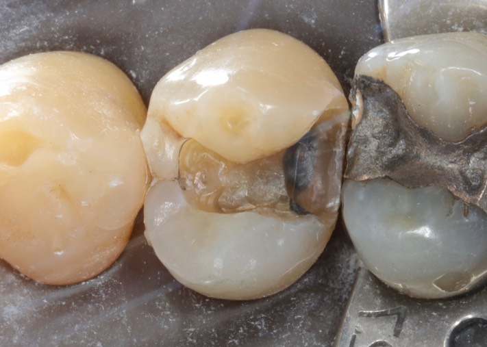 Brian Sato #5 caries removal