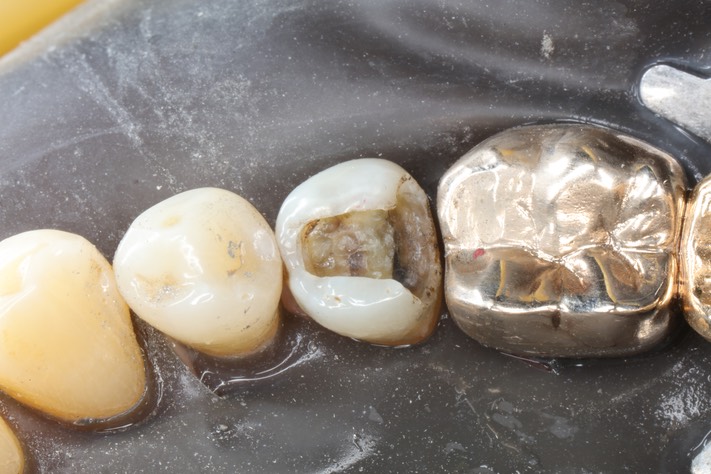 Bryan Sato #20 amalgam removal