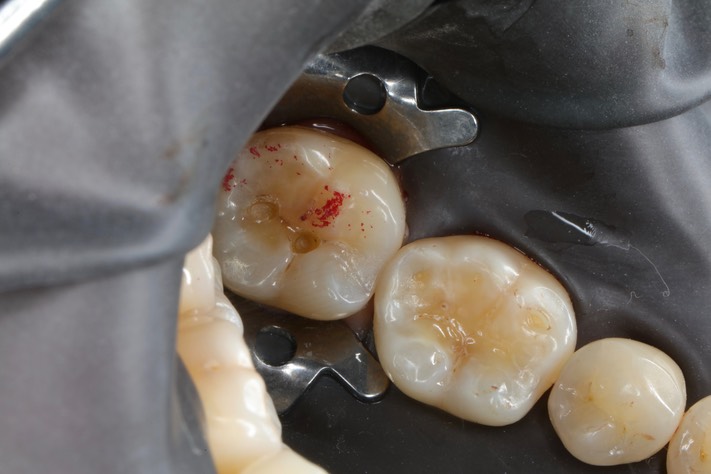 Bryan Sato #31 amalgam removal