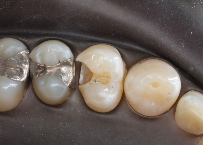 Chris Woo #12 caries removal