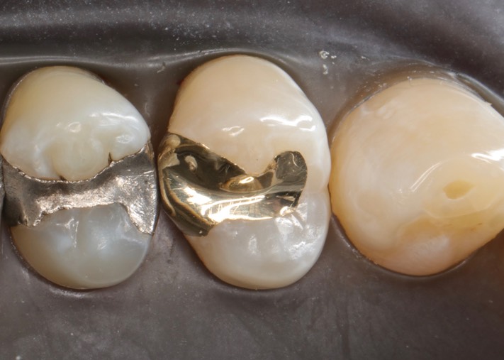 Chris Woo @12 pre-cementation