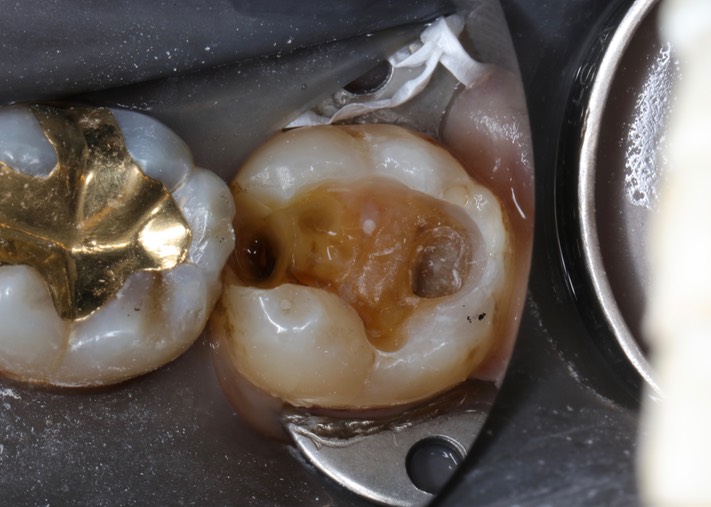 Chris Woo #18 composite removal