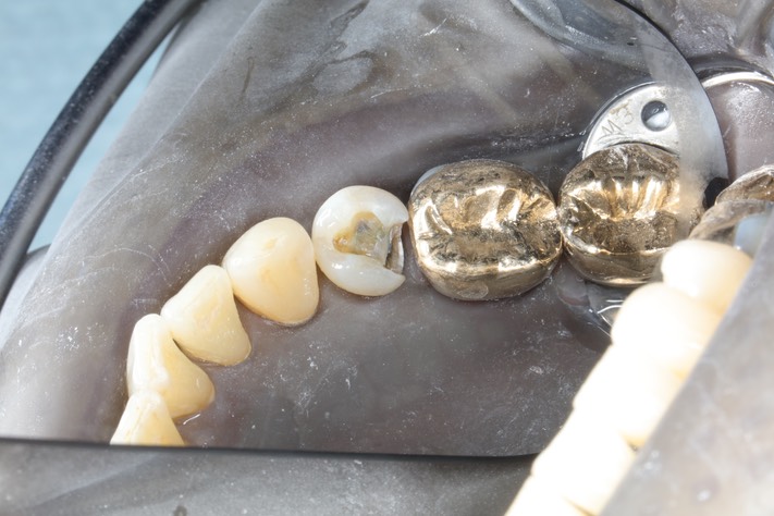 Chris Woo #20 composite removal