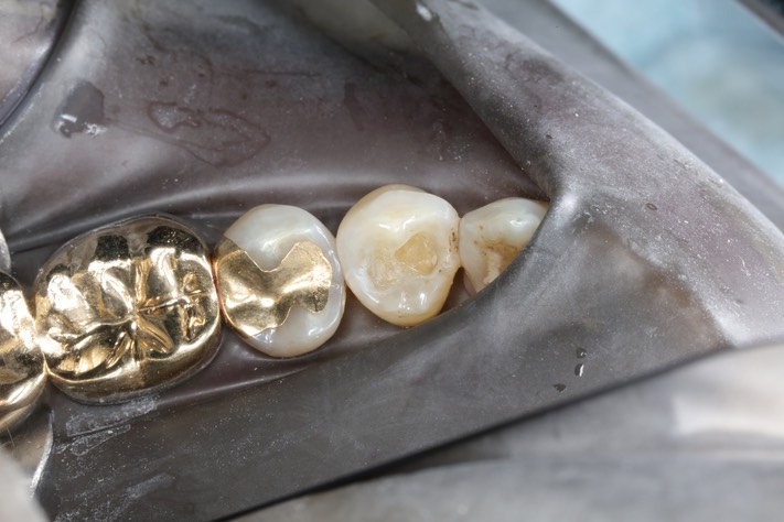 Chris Woo #28 composite removal