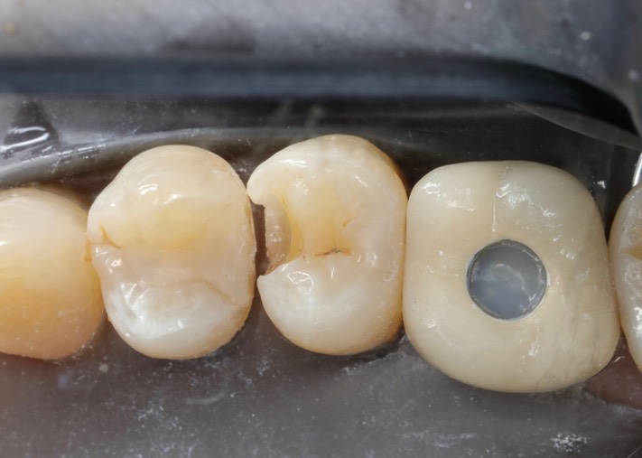 Chris Woo #4 composite removal