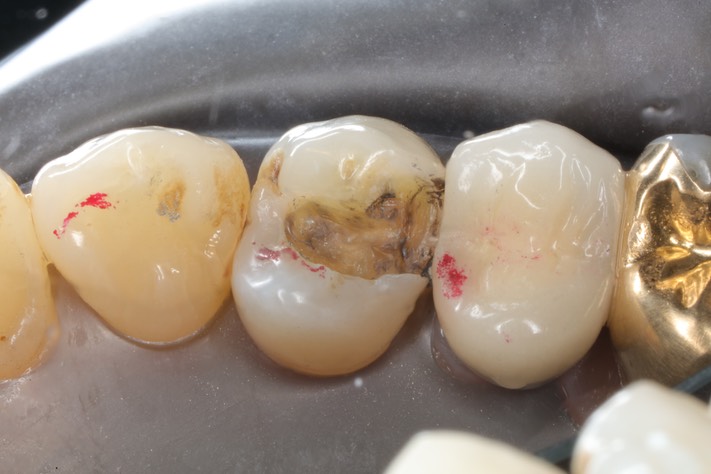 Chris Woo #5 amalgam removal