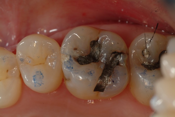 Larry Fujioka #3 pre-op