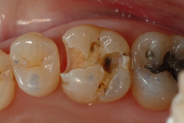 Larry Fujioka #3 caries removal